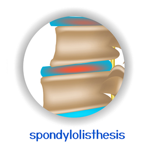 picture of Auburn spondylolisthesis